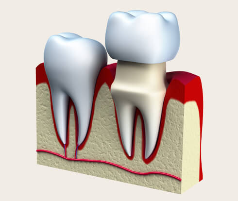 diagram of a dental crown