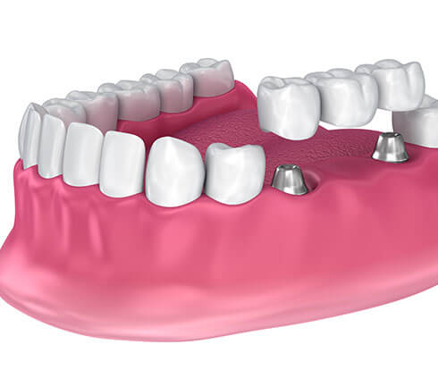 diagram of a dental bridge