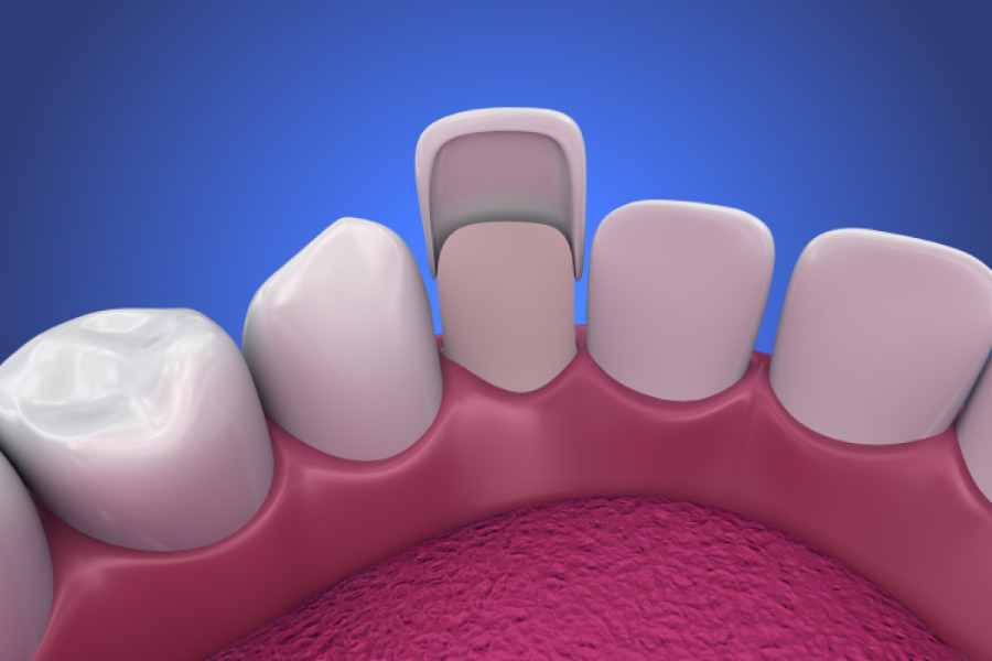 Model of a mouth showing the backside of a porcelain veneer attached to a single tooth