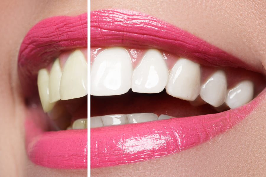 Close up smile with pink lipstick showing before and after teeth whitening.