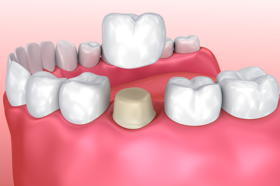 Graphic showing a dental crown on a bottom tooth.