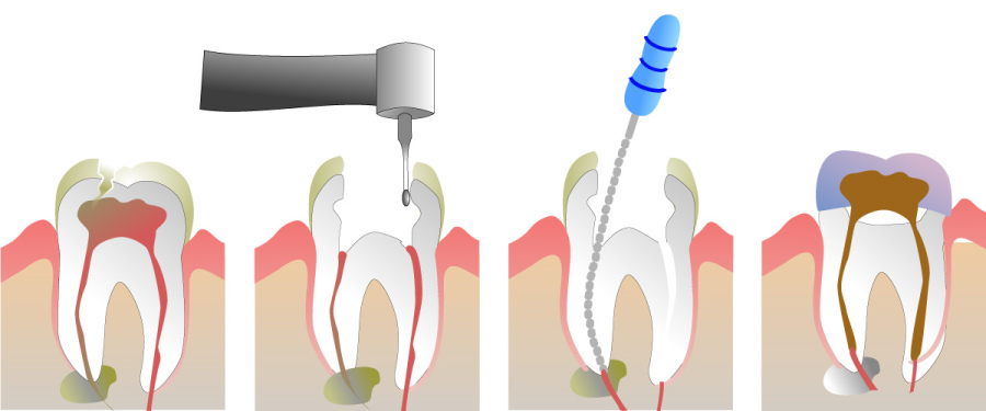 How Painful Is A Root Canal Bethea Family Dentistry Columbia Sc