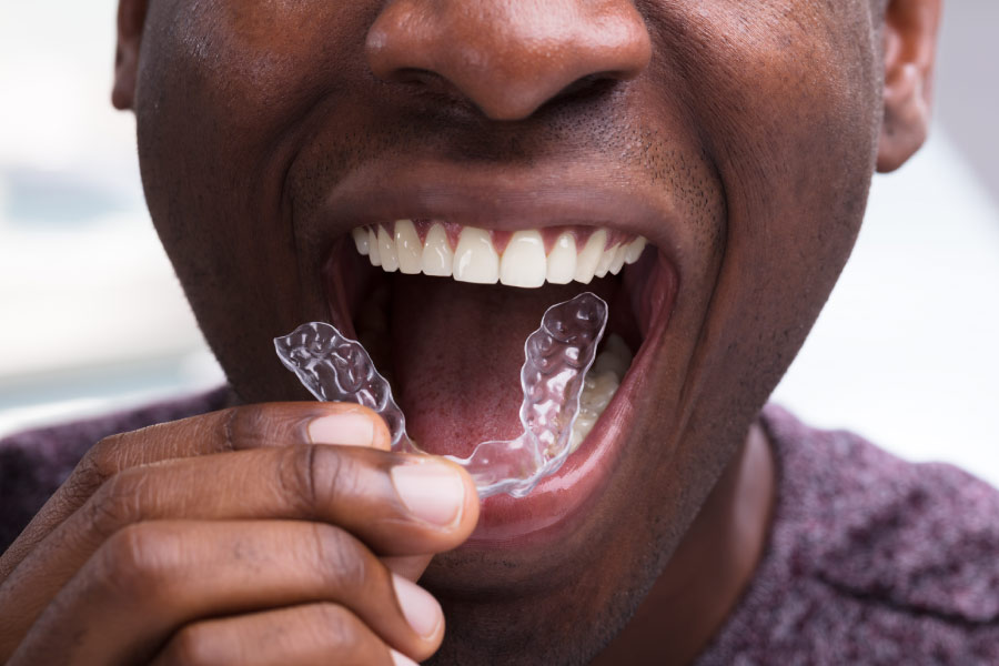 A black man with beautiful white teeth is inserting an Invisalign clear aligner.