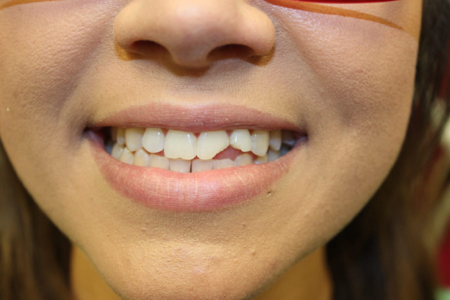 Close up of a smile with a broken tooth.