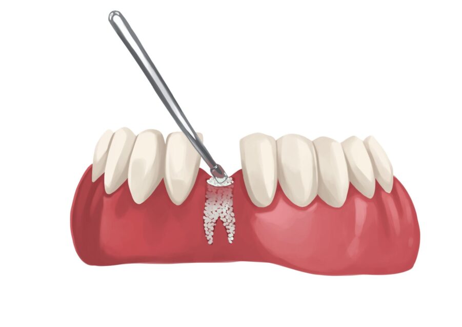 graphic illustration of placement of a bone graft on a tooth