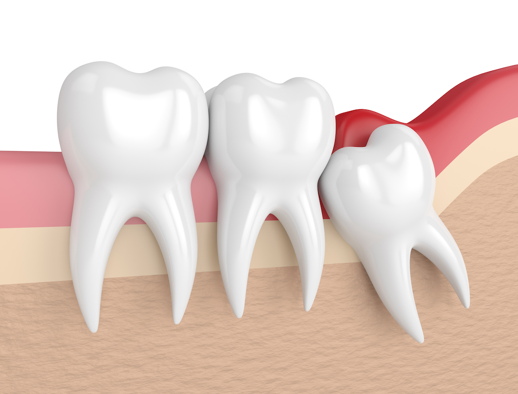 3d render of  wisdom mesial impaction with pericoronitis indicating wisdom teeth removal. Concept of different types of wisdom teeth problems.