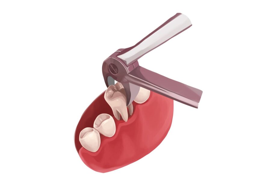 tooth extraction, tooth extractions, simple extraction, surgical extraction