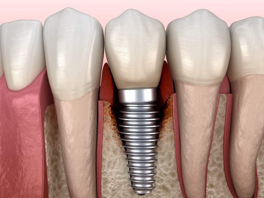 gum recession dental implants, dental implant care, receding gums, dental implants Columbia SC, gum disease prevention  