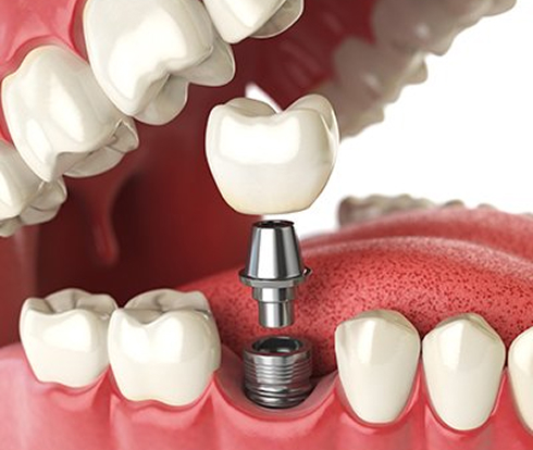 illustration of dental implant
