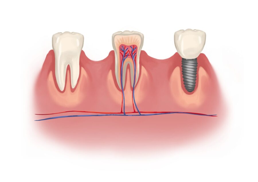 how dental implants preserve jawbone, dental implant