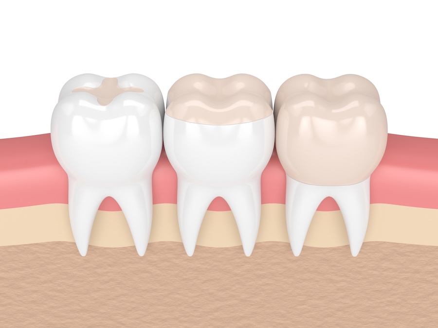 dental filling, onlay, and crown